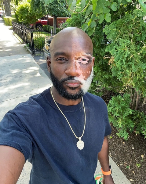 На этих фото показали, какие финты генетика вытворяет с людьми