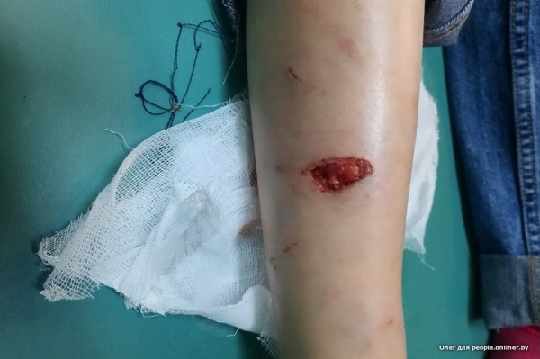 В Беларуси бультерьер набросился на 4-классницу, у нее рваные раны. Владельцы: он играл